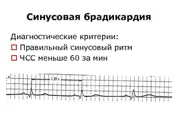 Синусовая брадикардия Диагностические критерии: o Правильный синусовый ритм o ЧСС меньше 60 за мин