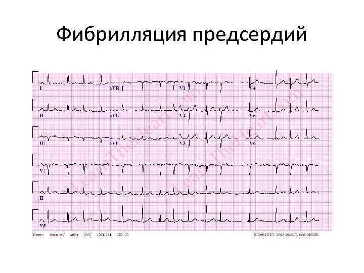 Фибрилляция предсердий 