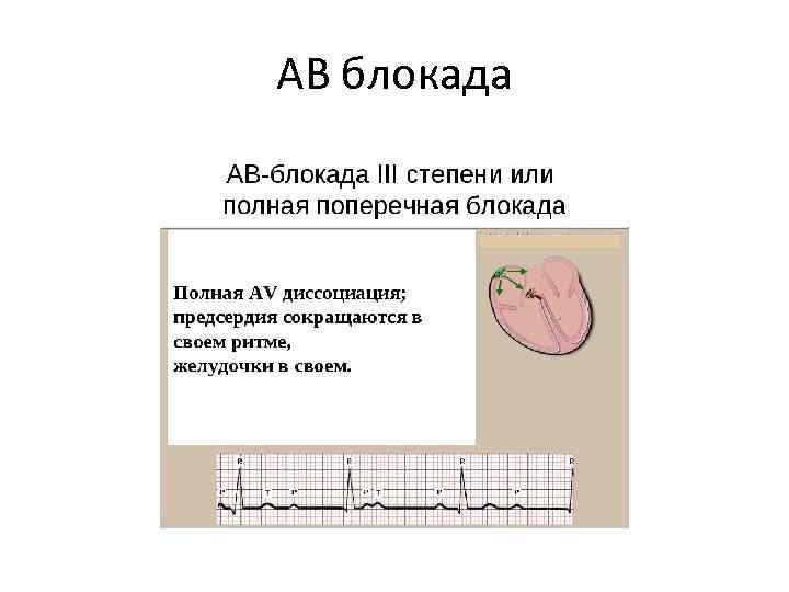 АВ блокада 