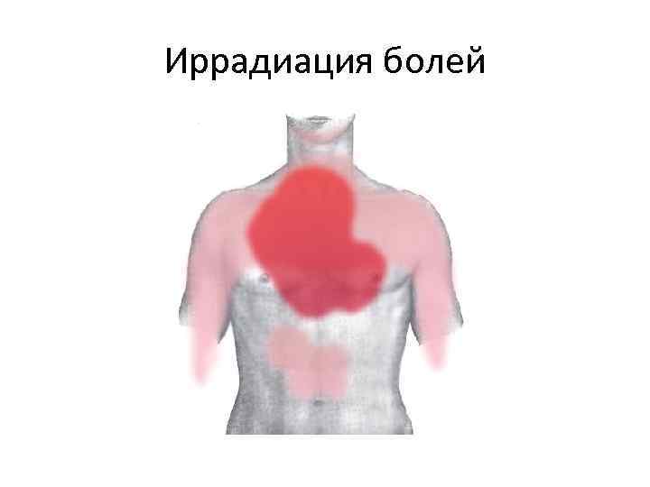Иррадиация болей 