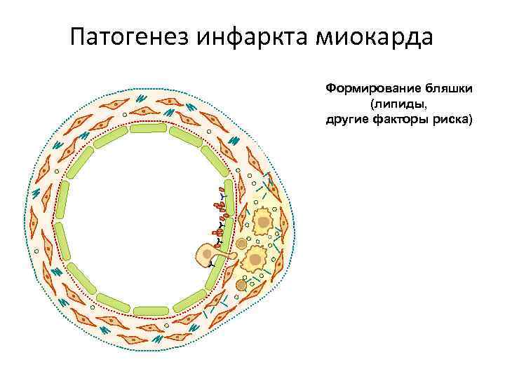 Патогенез инфаркта миокарда Формирование бляшки (липиды, другие факторы риска) 