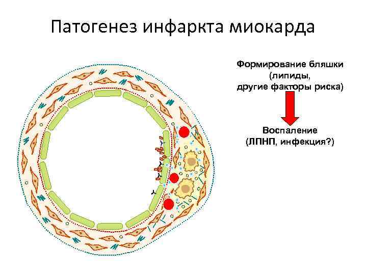 Патогенез инфаркта миокарда Формирование бляшки (липиды, другие факторы риска) Воспаление (ЛПНП, инфекция? ) 