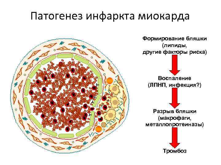Патогенез инфаркта миокарда Формирование бляшки (липиды, другие факторы риска) Воспаление (ЛПНП, инфекция? ) Разрыв
