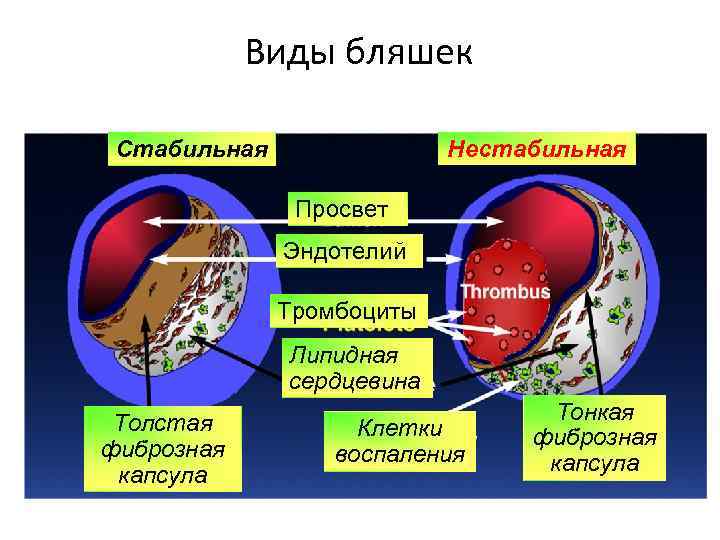 Виды бляшек Стабильная Нестабильная Просвет Эндотелий Тромбоциты Липидная сердцевина Толстая фиброзная капсула Клетки воспаления