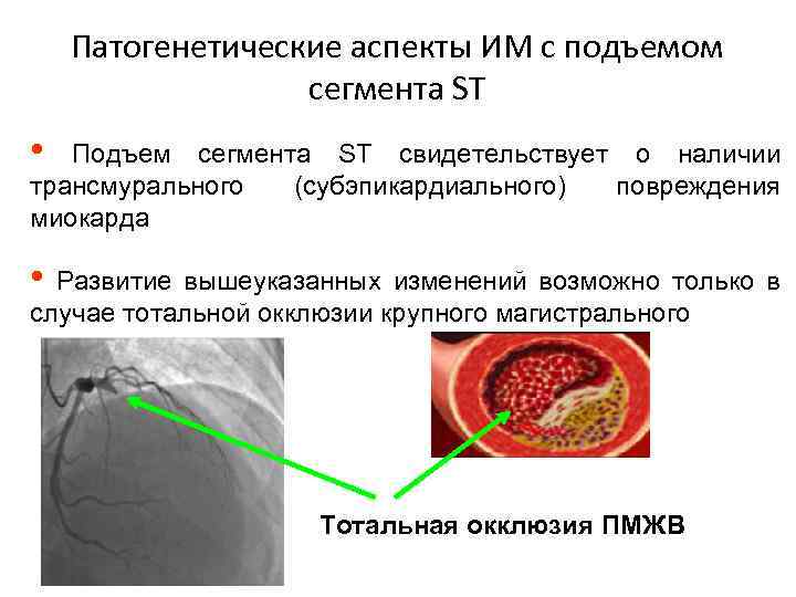 Патогенетические аспекты ИМ с подъемом сегмента ST • Подъем сегмента ST свидетельствует о наличии