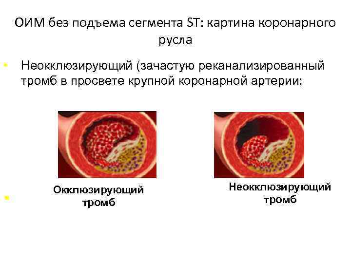 ОИМ без подъема сегмента ST: картина коронарного русла • § Неокклюзирующий (зачастую реканализированный тромб