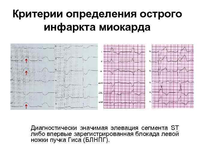 Критерии определения острого инфаркта миокарда Диагностически значимая элевация сегмента ST либо впервые зарегистрированная блокада