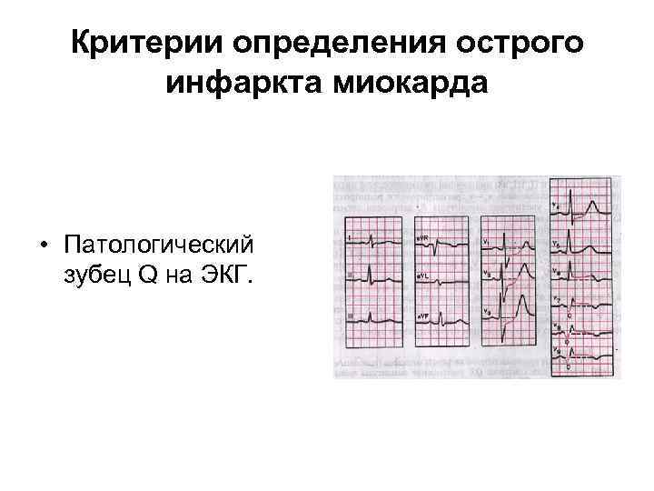 Критерии определения острого инфаркта миокарда • Патологический зубец Q на ЭКГ. 
