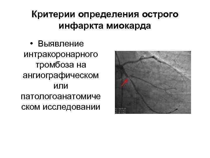 Критерии определения острого инфаркта миокарда • Выявление интракоронарного тромбоза на ангиографическом или патологоанатомиче ском