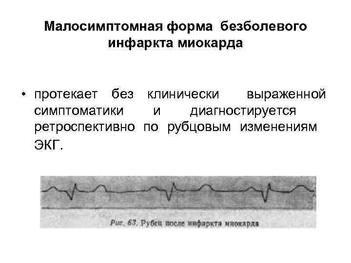 Малосимптомная форма безболевого инфаркта миокарда • протекает без клинически выраженной симптоматики и диагностируется ретроспективно