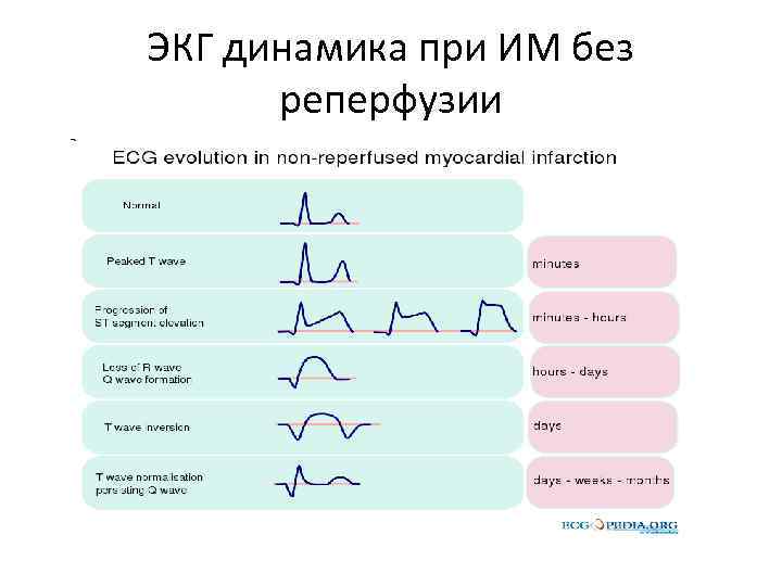 ЭКГ динамика при ИМ без реперфузии 