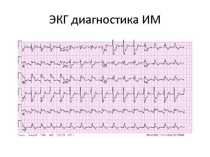 ЭКГ диагностика ИМ 