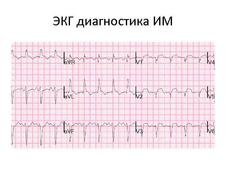 ЭКГ диагностика ИМ 