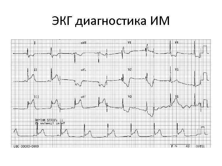 ЭКГ диагностика ИМ 