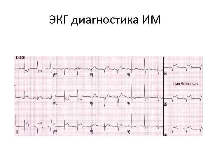 ЭКГ диагностика ИМ 