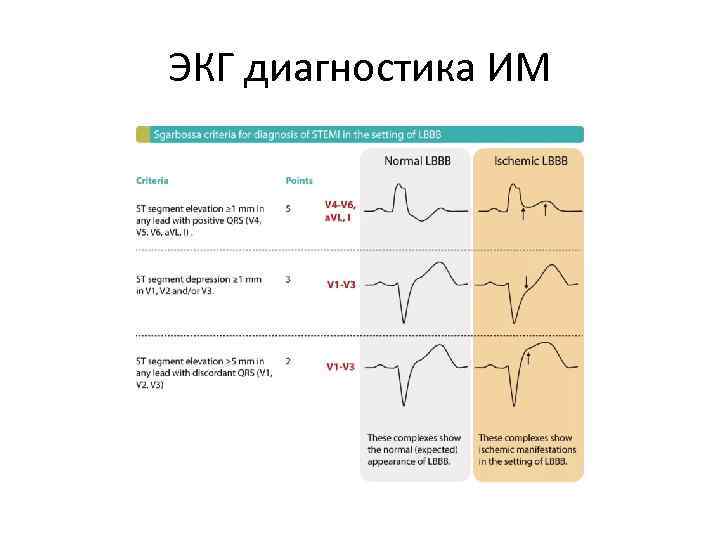 ЭКГ диагностика ИМ 