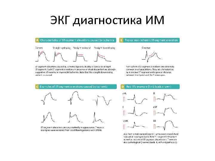 ЭКГ диагностика ИМ 