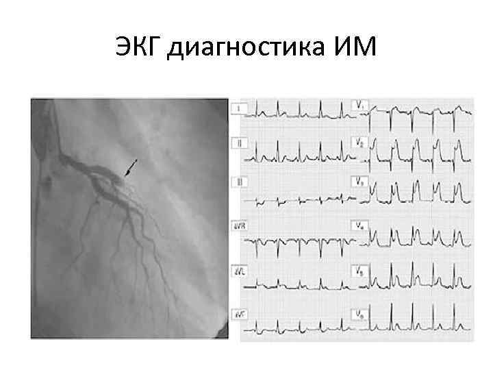 ЭКГ диагностика ИМ 