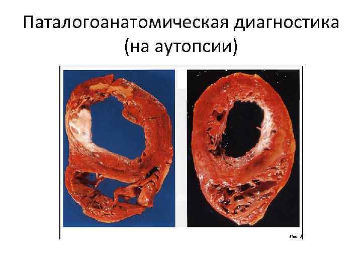 Паталогоанатомическая диагностика (на аутопсии) 