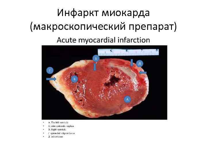 Инфаркт миокарда (макроскопический препарат) 