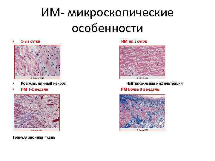 ИМ- микроскопические особенности • 1 -ые сутки ИМ до 3 суток • • Коагуляционный