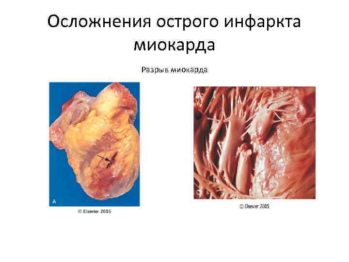 Осложнения острого инфаркта миокарда Разрыв миокарда 