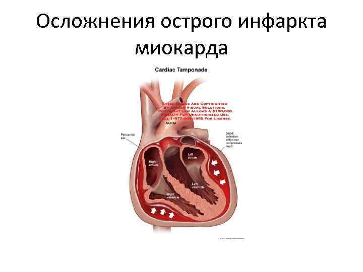 Осложнения острого инфаркта миокарда 