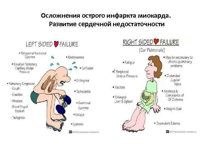 Осложнения острого инфаркта миокарда. Развитие сердечной недостаточности 