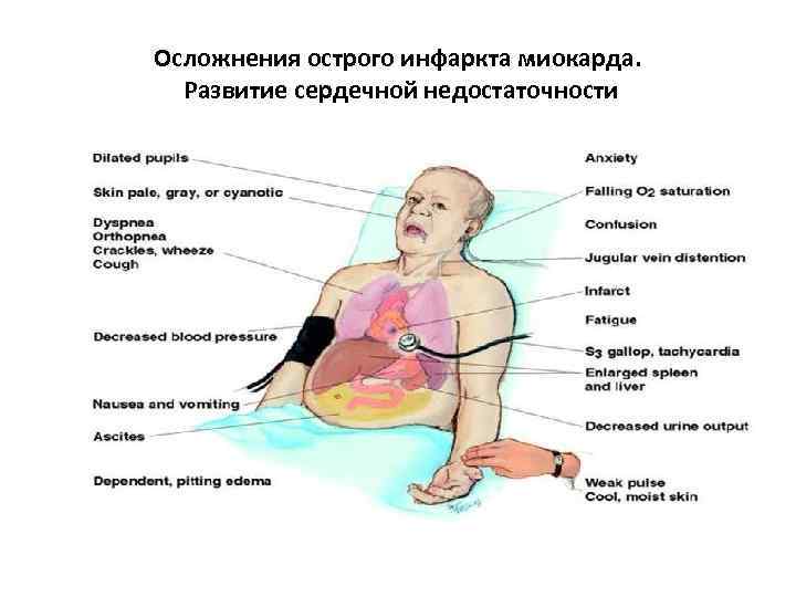 Осложнения острого инфаркта миокарда. Развитие сердечной недостаточности 