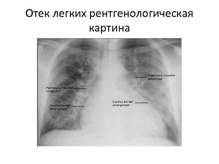 Отек легких рентгенологическая картина 