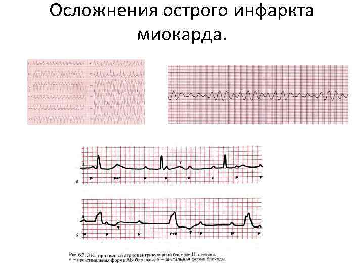 Осложнения острого инфаркта миокарда. 