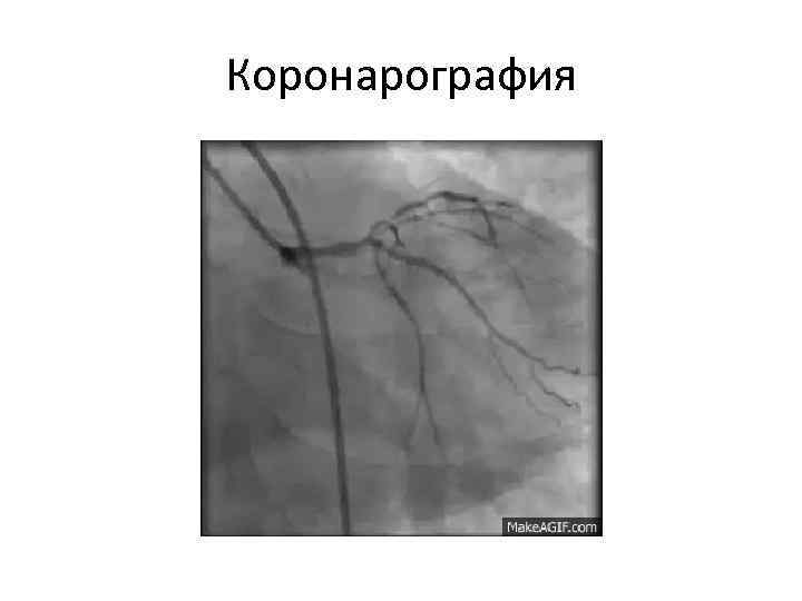 Показания к коронарографии