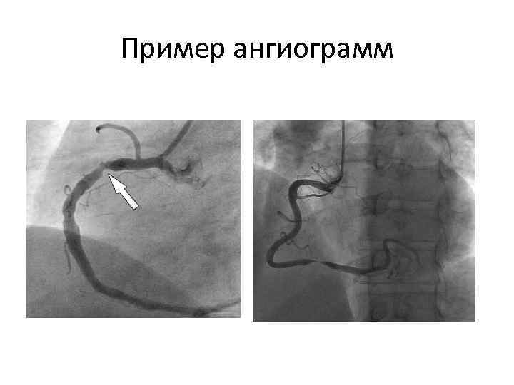 Пример ангиограмм 