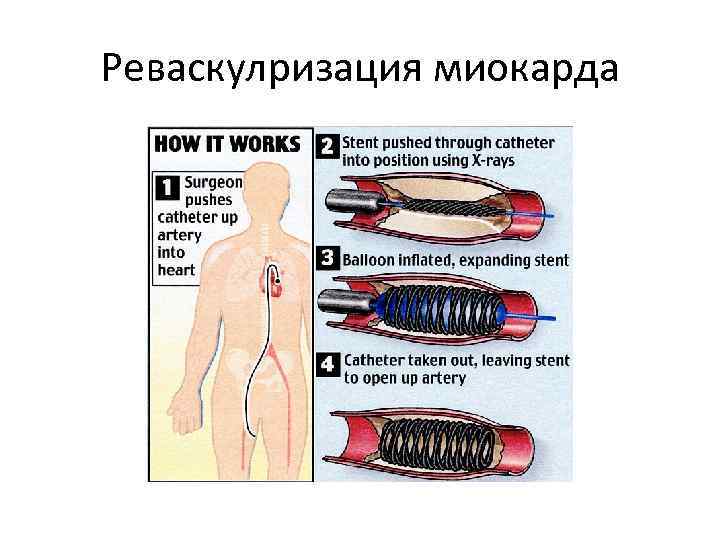 Реваскулризация миокарда 