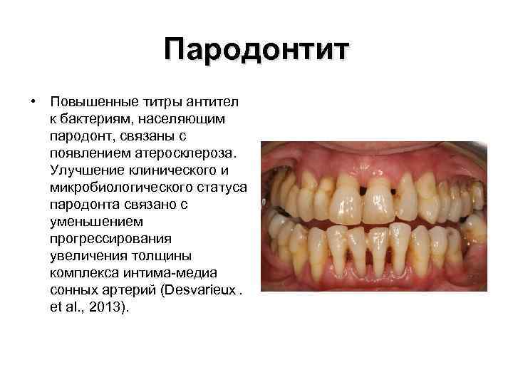 Пародонтит • Повышенные титры антител к бактериям, населяющим пародонт, связаны с появлением атеросклероза. Улучшение