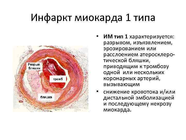 Инфаркт миокарда 1 типа • ИМ тип 1 характеризуется: разрывом, изъязвлением, эрозированием или расслоением