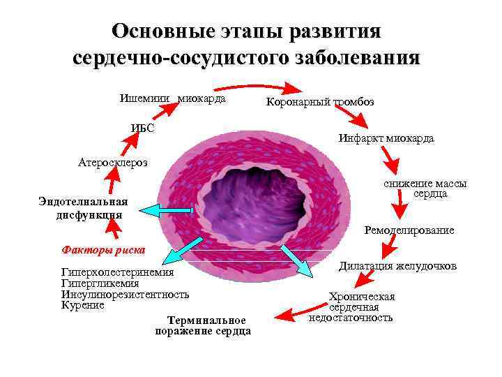 Основные этапы развития сердечно-сосудистого заболевания Ишемииия миокарда ИБС Атеросклероз Эндотелиальная дисфункция Коронарный тромбоз Инфаркт