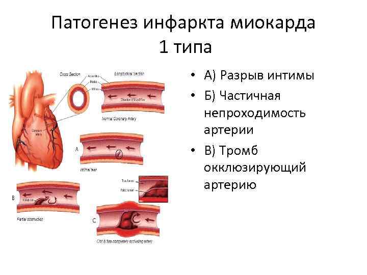 Патогенез инфаркта миокарда 1 типа • А) Разрыв интимы • Б) Частичная непроходимость артерии