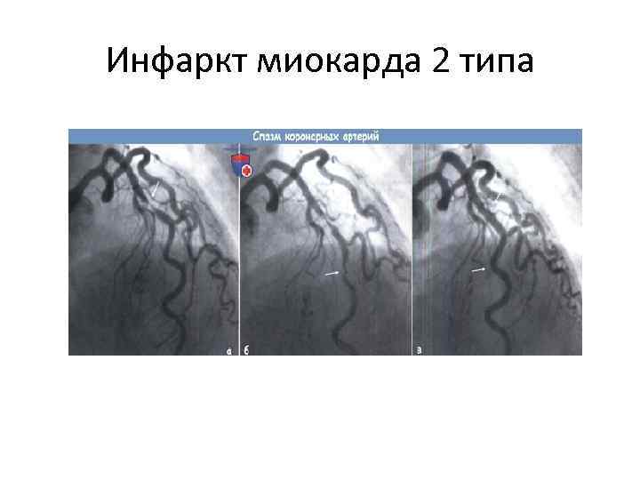 Инфаркт миокарда 2 типа 