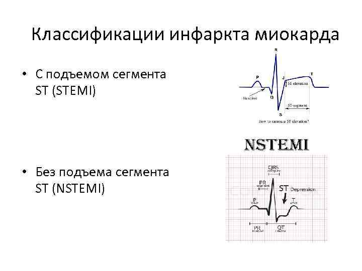 Классификации инфаркта миокарда • С подъемом сегмента ST (STEMI) • Без подъема сегмента ST