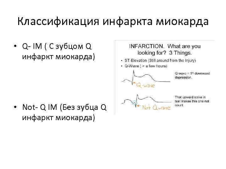 Классификация инфаркта миокарда • Q- IM ( С зубцом Q инфаркт миокарда) • Not-