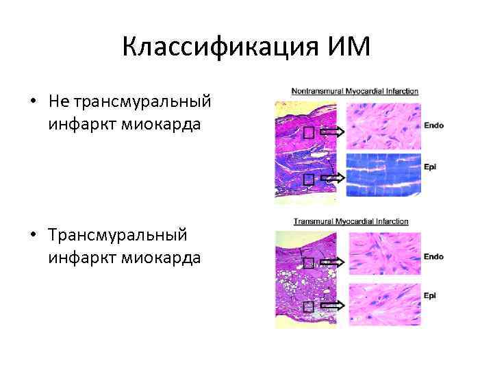 Классификация ИМ • Не трансмуральный инфаркт миокарда • Трансмуральный инфаркт миокарда 