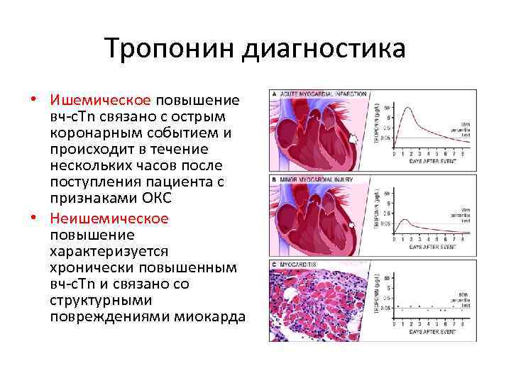 Тропонин диагностика • Ишемическое повышение вч-c. Tn связано с острым коронарным событием и происходит