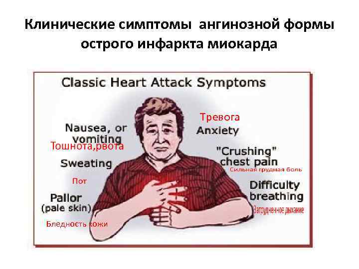 Основной симптом при ангинозной форме инфаркта миокарда