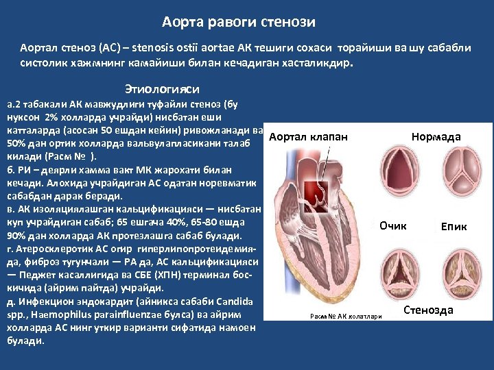 Аорта равоги стенози Аортал стеноз (АС) – stenosis ostii aortae АК тешиги сохаси торайиши