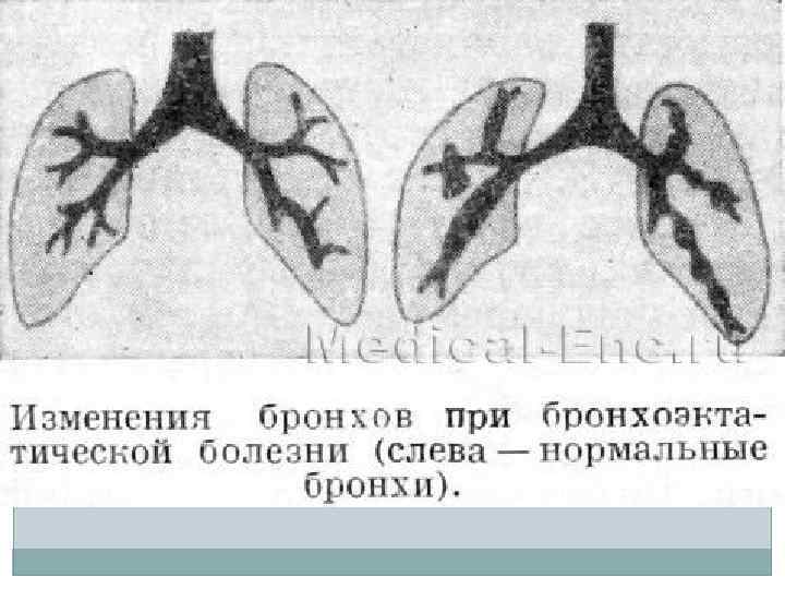 Бронхообструктивный синдром у детей презентация