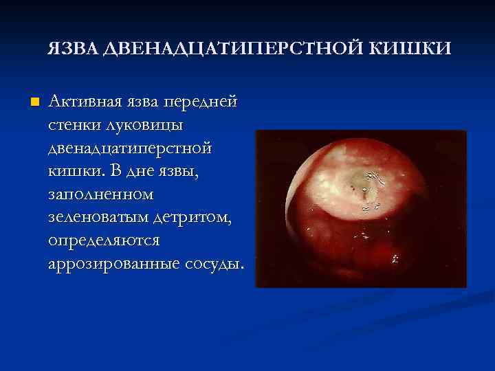  ЯЗВА ДВЕНАДЦАТИПЕРСТНОЙ КИШКИ n Активная язва передней стенки луковицы двенадцатиперстной кишки. В дне