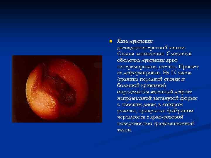 n Язва луковицы двенадцатиперстной кишки. Стадия заживления. Слизистая оболочка луковицы ярко гиперемирована, отечна. Просвет
