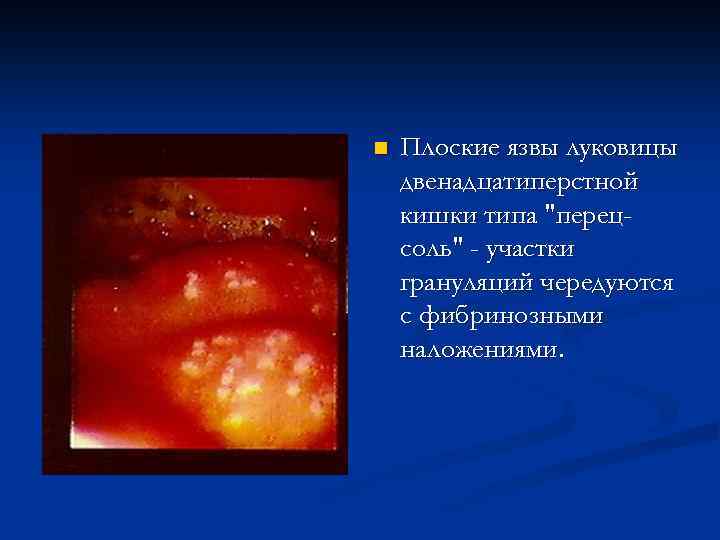 n Плоские язвы луковицы двенадцатиперстной кишки типа "перецсоль" - участки грануляций чередуются с фибринозными