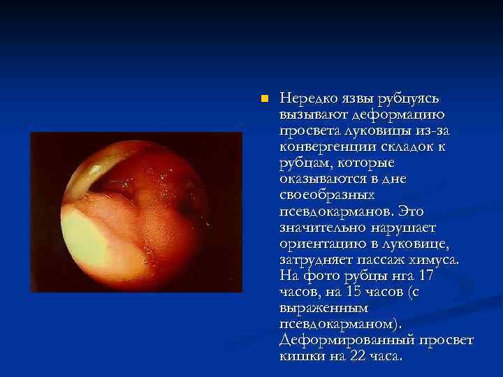 n Нередко язвы рубцуясь вызывают деформацию просвета луковицы из-за конвергенции складок к рубцам, которые